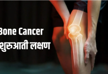 Photo of ये 5 लक्षण दिखें तो समझ जाएं हो गया है Bone Cancer, समय रहते नहीं दिया ध्यान तो पड़ जाएंगे लेने के देने