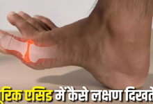 Photo of सिर्फ रात में दिखाई देते हैं यूरिक एसिड बढ़ने के ये 4 लक्षण