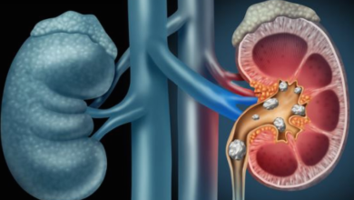 Photo of लाइफस्टाइल की ये तीन गतली बढ़ा देती है किडनी स्टोन का खतरा