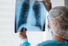 Photo of कमजोर इम्युनिटी और खराब जीवनशैली दे रही टीबी को न्योता