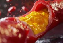 Photo of क्या बिना किसी लक्षण के शरीर में बढ़ सकता है कोलेस्ट्रॉल? 