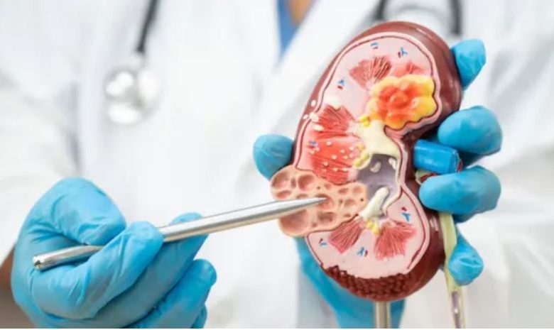Photo of किडनी डिजीज को साइलेंट किलर क्यों कहा जाता है?