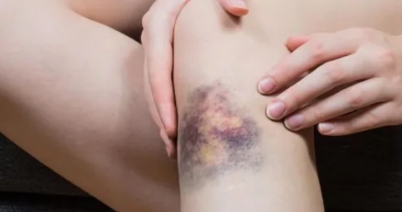 Photo of बिना चोट के शरीर पर नील पड़ना या जोड़ों में दर्द हो सकता है इस गंभीर बीमारी का संकेत