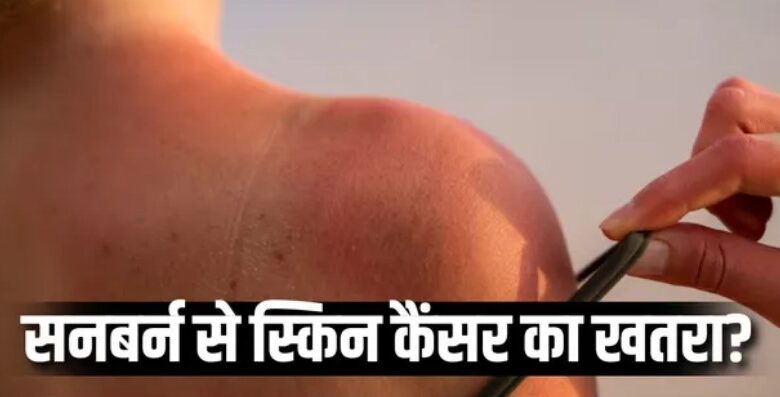 Photo of बार-बार सनबर्न से बढ़ जाता है स्किन कैंसर का खतरा